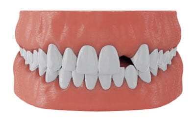 The Causes and Risks of Missing Tooth