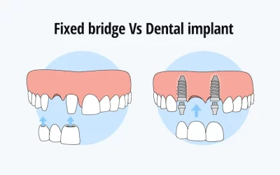 Dental Implants vs. Dentures