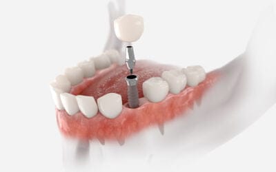 What are Dental Implants and How do They Work?