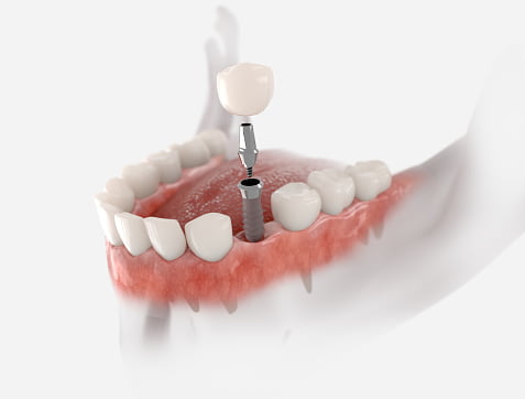 What are Dental Implants and How do They Work?