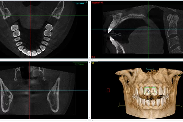 Dental 3D Xrays