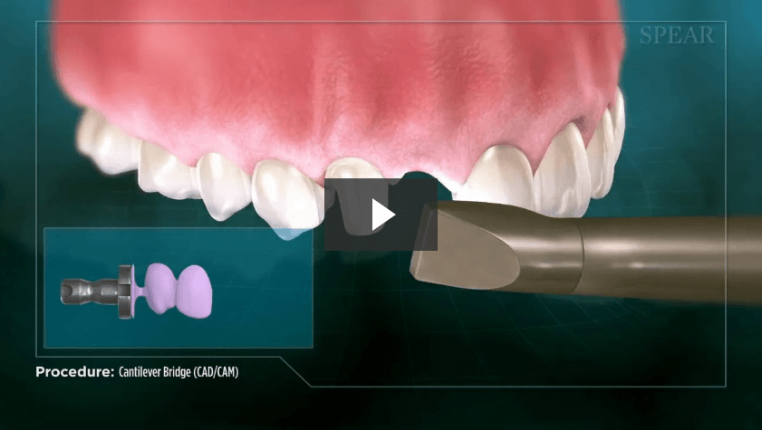 Cantilever Bridge (CAD/CAM) - Cosmetic Dentistry