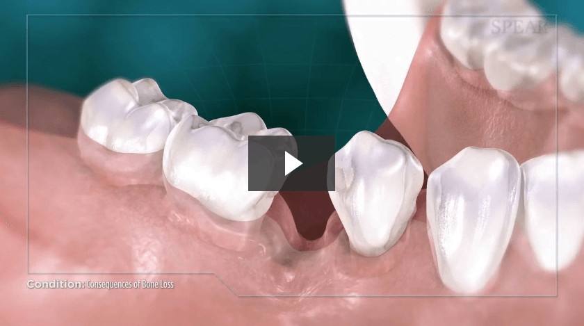 Consequences of Bone Loss