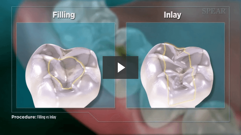 Filling vs Inlay