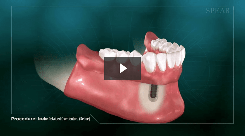 Locator Retained Overdenture (Reline)