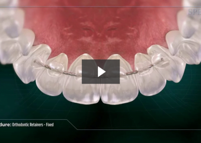 Orthodontic Retainers- Fixed