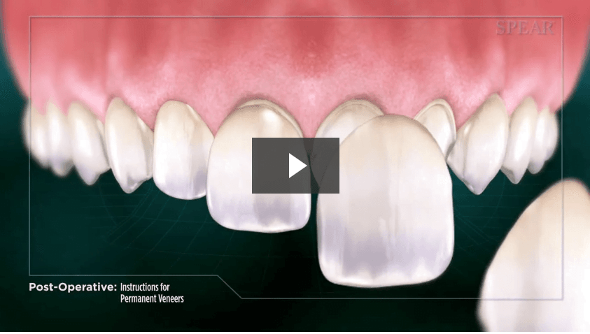 Post-Operative Instructions for Permanent Veneers