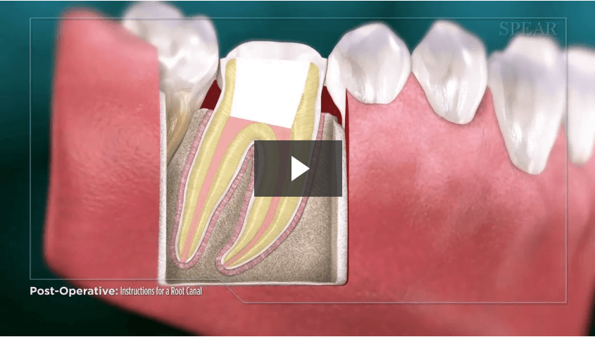 Post-Operative Instructions for a Root Canal