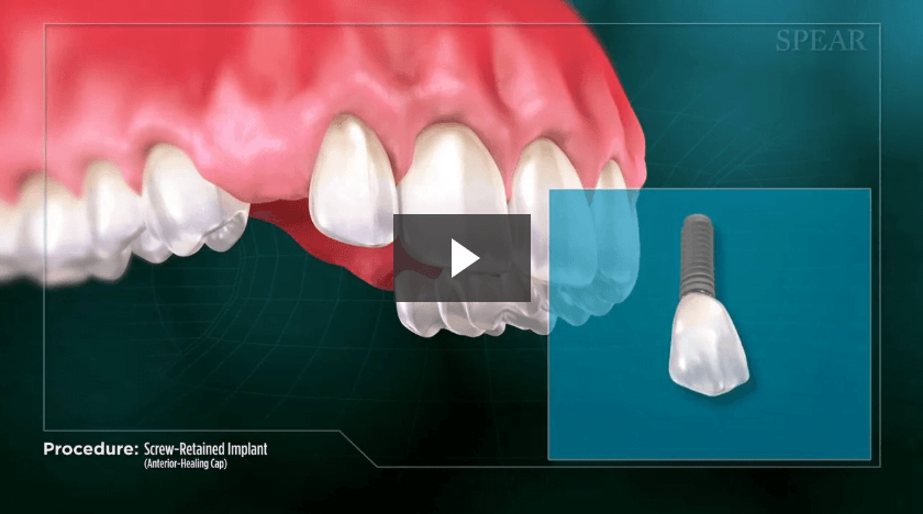 Screw-Retained Implant (Anterior- Healing Cap)