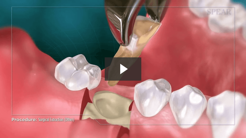 Surgical Extraction (Other)