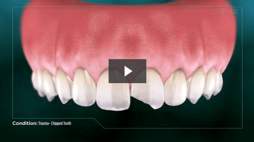 Trauma- Chipped Tooth