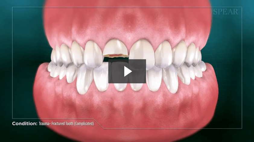Trauma- Fractured Tooth (Complicated)