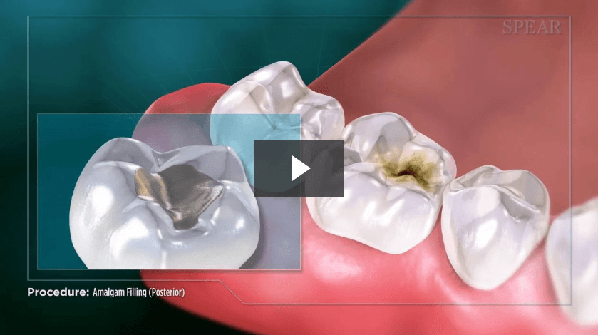 Amalgam Filling (Posterior)