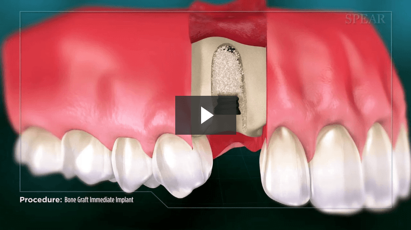 Bone Graft with Immediate Implant Placement