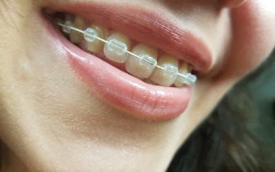 What Is The Age For Braces?