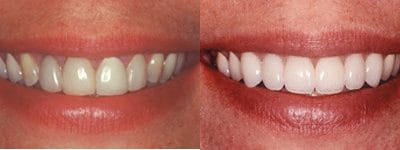Teeth Whitening: What are the Options?