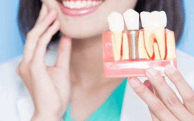 What Are Dental Implants?
