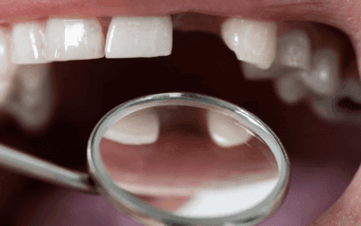 What Happens If You Don’t Replace Missing Teeth