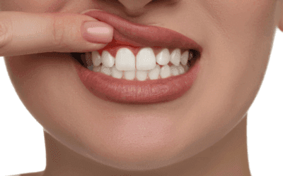 5 Reasons to Consider Gum Grafting