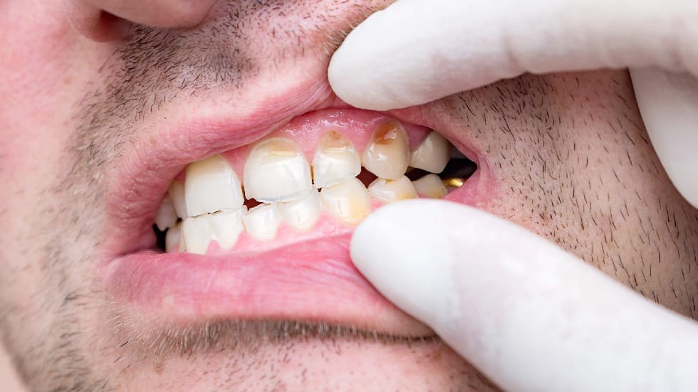 What to Do If You Chip or Break a Tooth: Emergency Steps