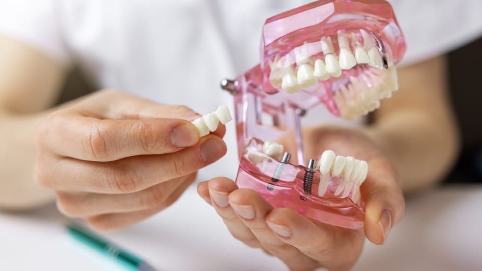 Dental Implants in Oshawa: Cost, Process & Who Qualifies